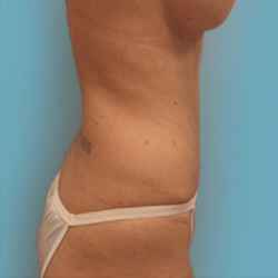 Manhattan abdominoplasty after 2